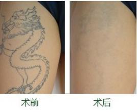去纹身