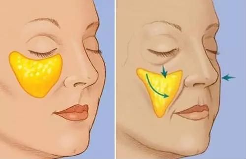 ͺҽԺ֬ƻӦעʲô