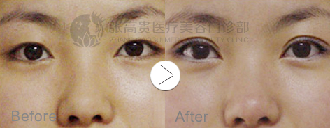 双眼皮11