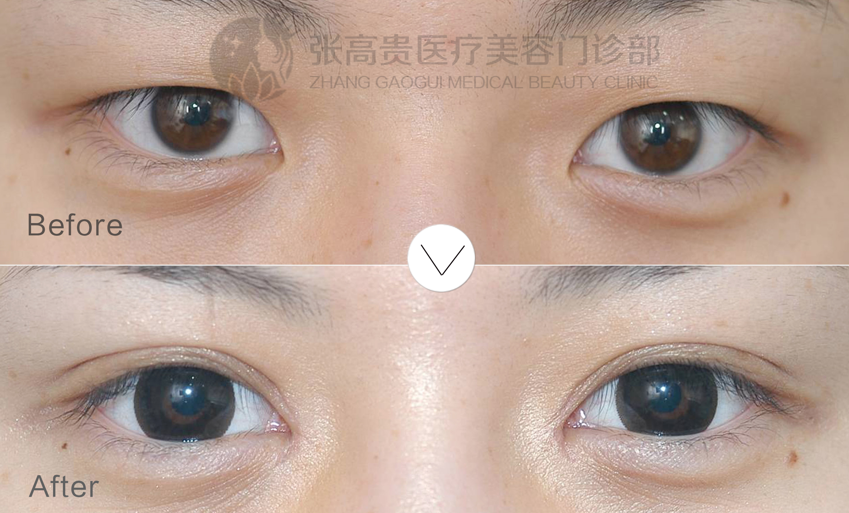 双眼皮开眼角