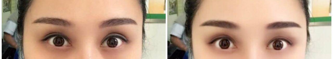 黑眼圈使用激光可以去除吗?