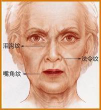 呼和浩特整形祛除皱纹