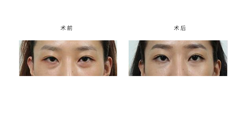双眼皮