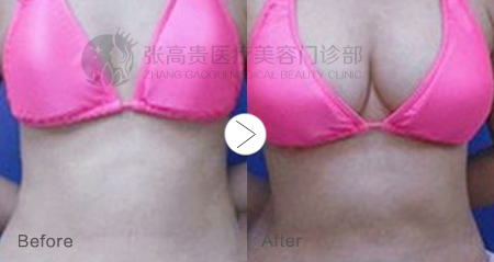 隆胸3